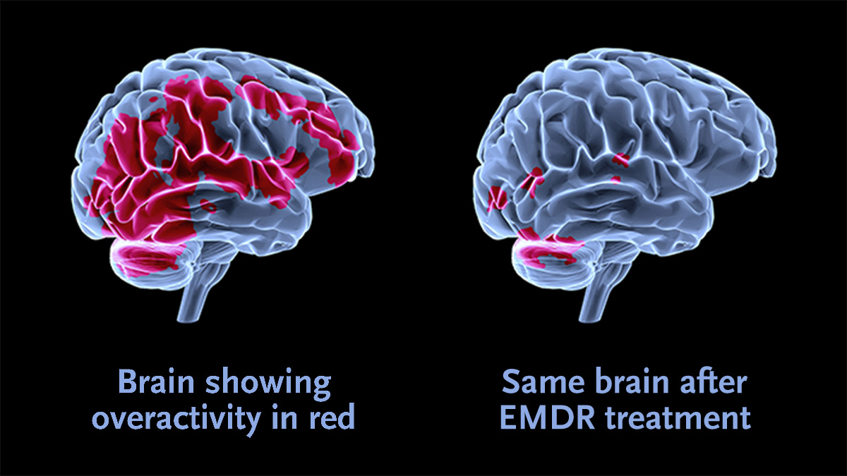 EMDR